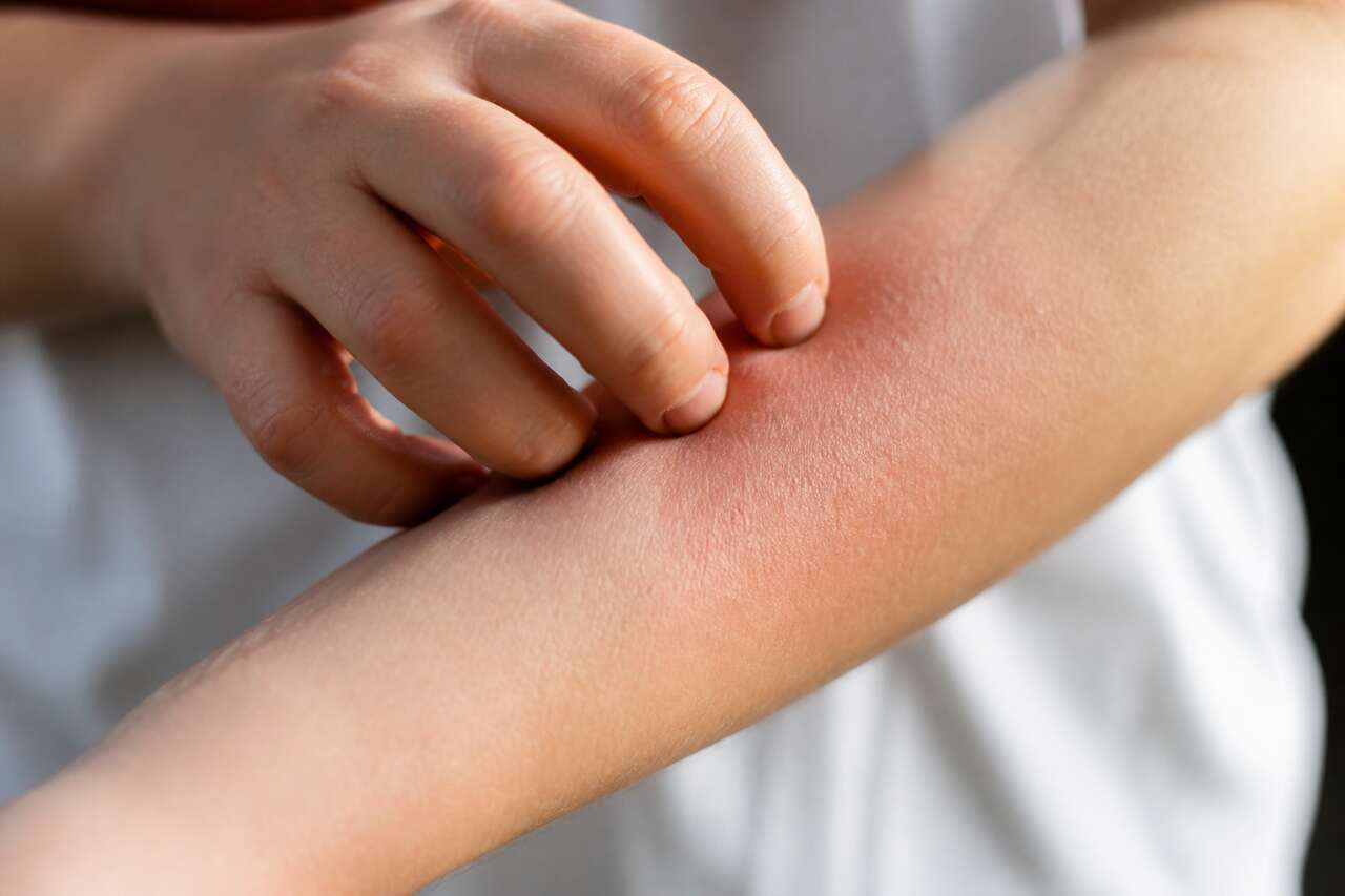 Causes et traitements du prurit cutané
