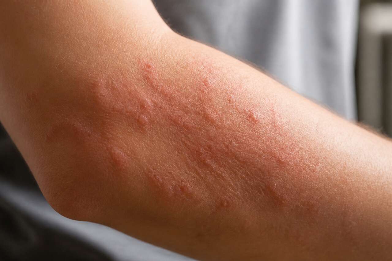 Définition et symptômes du prurit cutané Définition et symptômes du prurit cutané