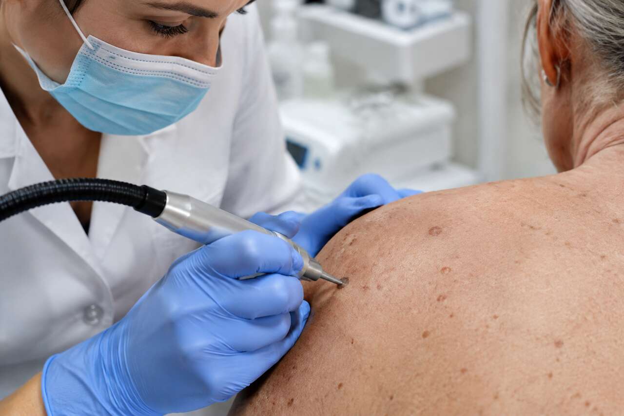 Traitements dermatologiques pour enlever une kératose : options et résultats attendus Traitements dermatologiques pour enlever une kératose : options et résultats attendus